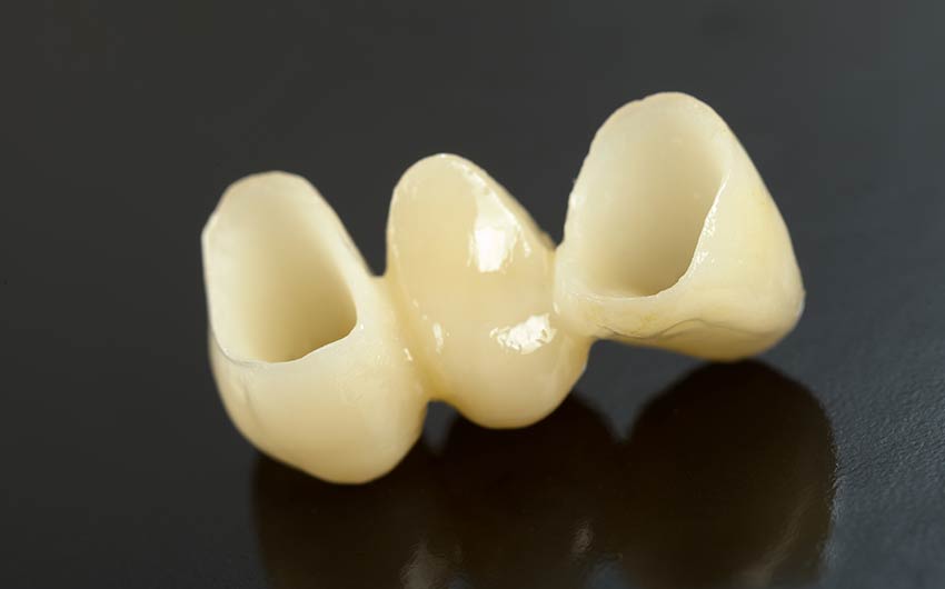 Dental Bridges | Dental on 8th | SE Calgary | General and Family Dentist