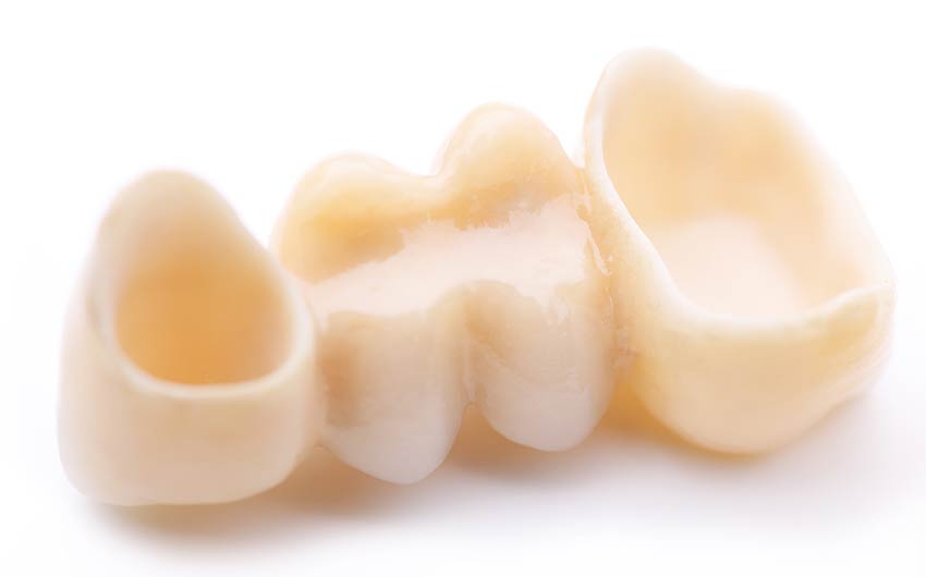 Dental Bridges | Dental on 8th | SE Calgary | General and Family Dentist