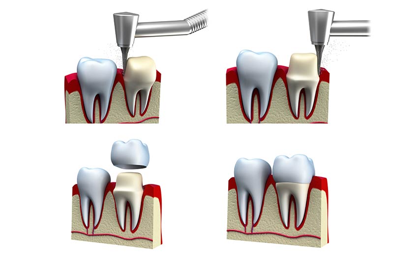 Dental Crowns | Dental on 8th | SE Calgary | General and Family Dentist