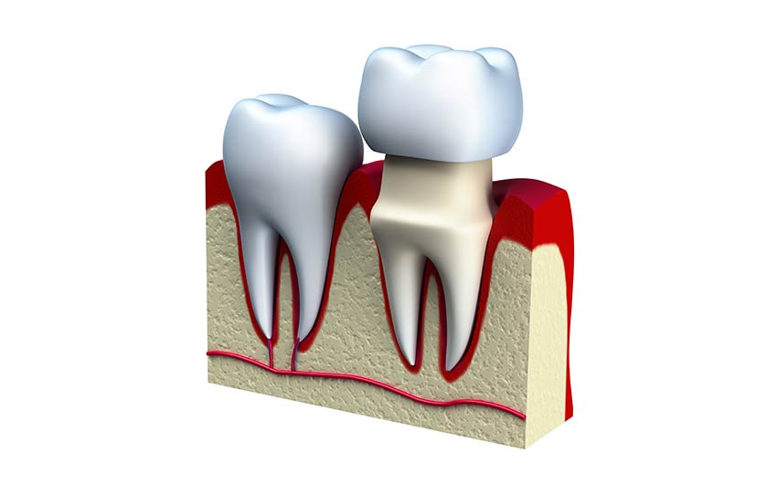 Dental Crowns | Dental on 8th | SE Calgary | General and Family Dentist