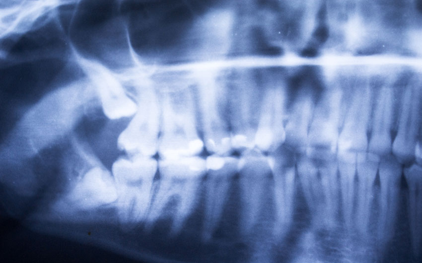 Wisdom Teeth Extraction | Dental on 8th | SE Calgary | General and Family Dentist