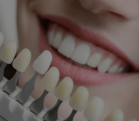 Porcelain Veneers | Dental on 8th | SE Calgary | General and Family Dentist