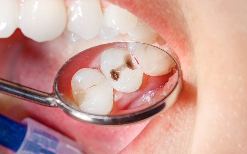 Tooth Coloured Fillings | Dental on 8th | SE Calgary | General and Family Dentist
