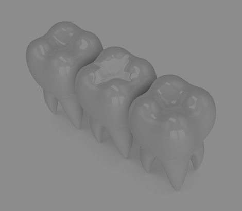 Tooth Coloured Fillings | Dental on 8th | SE Calgary | General and Family Dentist