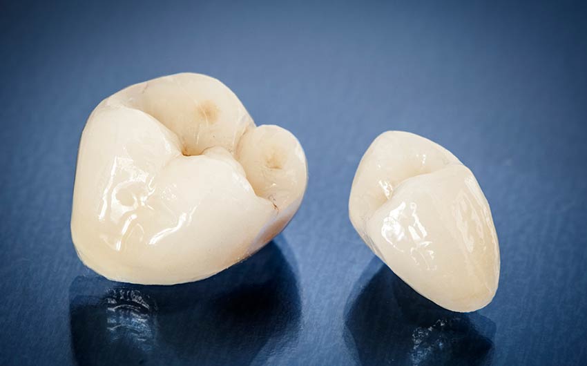 Dental Crowns | Dental on 8th | SE Calgary | General and Family Dentist