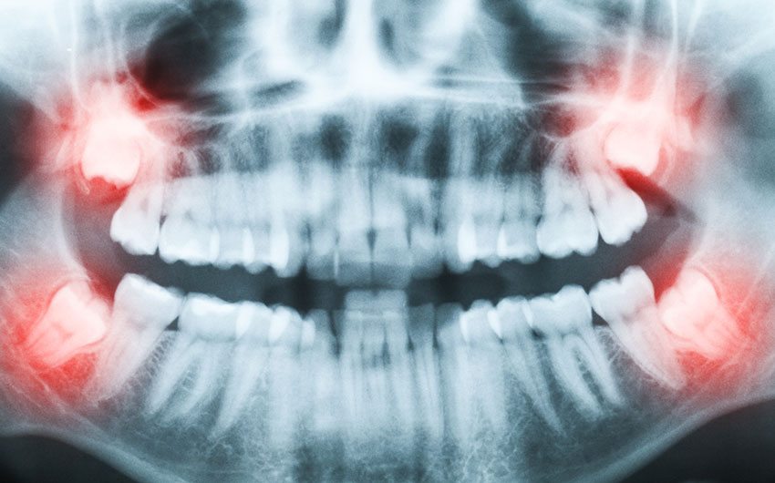 Wisdom Teeth Extraction | Dental on 8th | SE Calgary | General and Family Dentist